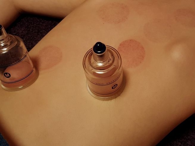 cupping-3310182_960_720.jpg